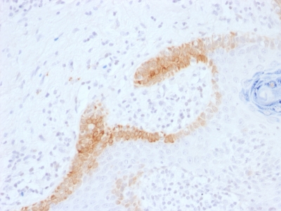 Formalin-fixed, paraffin-embedded human Basal Cell Carcinoma stained with Cytokeratin 15 Monoclonal Antibody (KRT15/1699).