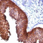 Formalin-fixed, paraffin-embedded human Cervical Carcinoma stained with CK17 Monoclonal Antibody (E3).