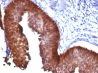 Formalin-fixed, paraffin-embedded human Cervical Carcinoma stained with CK17 Monoclonal Antibody (E3).