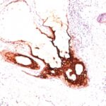 Formalin-fixed, paraffin-embedded human Skin stained with CK17 Monoclonal Antibody (SPM56).