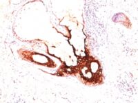 Formalin-fixed, paraffin-embedded human Skin stained with CK17 Monoclonal Antibody (SPM56).