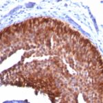 Formalin-fixed, paraffin-embedded human Cervical Carcinoma stained with CK17 Monoclonal Antibody (KRT17/778).