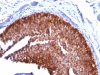 Formalin-fixed, paraffin-embedded human Cervical Carcinoma stained with CK17 Monoclonal Antibody (KRT17/778).