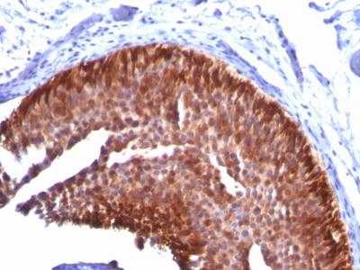 Formalin-fixed, paraffin-embedded human Cervical Carcinoma stained with CK17 Monoclonal Antibody (KRT17/778).