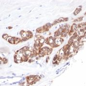 Formalin-fixed, paraffin-embedded human Breast Carcinoma stained with Cytokeratin 18 Monoclonal Antibody (SPM51).
