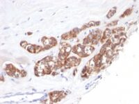 Formalin-fixed, paraffin-embedded human Breast Carcinoma stained with Cytokeratin 18 Monoclonal Antibody (SPM51).