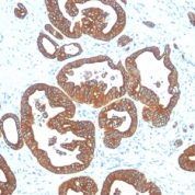 Formalin-fixed, paraffin-embedded human Colon Carcinoma stained with Cytokeratin 18 Monoclonal Antibody (DE-K18).
