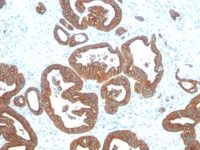 Formalin-fixed, paraffin-embedded human Colon Carcinoma stained with Cytokeratin 18 Monoclonal Antibody (DE-K18).