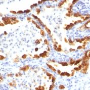 Formalin-fixed, paraffin-embedded human Thyroid Carcinoma stained with Cytokeratin 18 Monoclonal Antibody (KRT18/835).