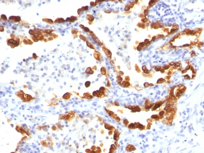Formalin-fixed, paraffin-embedded human Thyroid Carcinoma stained with Cytokeratin 18 Monoclonal Antibody (KRT18/835).