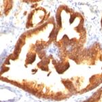 Formalin-fixed, paraffin-embedded human Prostate Carcinoma stained with Cytokeratin 18 Monoclonal Antibody (KRT18/836).