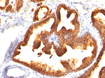 Formalin-fixed, paraffin-embedded human Prostate Carcinoma stained with Cytokeratin 18 Monoclonal Antibody (KRT18/836).