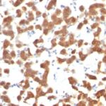 Formalin-fixed, paraffin-embedded human Thyroid Carcinoma stained with Cytokeratin 18 Monoclonal Antibody (C-4).