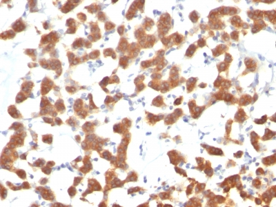 Formalin-fixed, paraffin-embedded human Thyroid Carcinoma stained with Cytokeratin 18 Monoclonal Antibody (C-4).