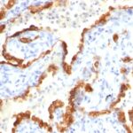 Formalin-fixed, paraffin-embedded human Thyroid Carcinoma stained with Cytokeratin 18 Monoclonal Antibody (Cocktail).