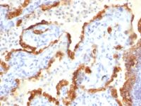 Formalin-fixed, paraffin-embedded human Thyroid Carcinoma stained with Cytokeratin 18 Monoclonal Antibody (Cocktail).