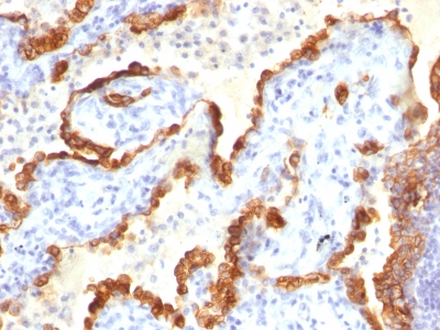 Formalin-fixed, paraffin-embedded human Thyroid Carcinoma stained with Cytokeratin 18 Monoclonal Antibody (Cocktail).