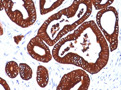 Formalin-fixed, paraffin-embedded human Colon Carcinoma stained with Cytokeratin 19 Monoclonal Antibody (BA17)