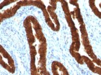 Formalin-fixed, paraffin-embedded human Endometrial Carcinoma stained with Cytokeratin 19 Monoclonal Antibody (KRT19/8)