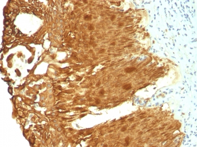 Formalin-fixed, paraffin-embedded human Bladder Carcinoma stained with Cytokeratin 19 Monoclonal Antibody (KRT19/799 + KRT19/8)