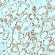 Formalin-fixed, paraffin-embedded human Renal Cell Carcinoma stained with Laminin Monoclonal Antibody (A5).