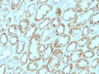 Formalin-fixed, paraffin-embedded human Renal Cell Carcinoma stained with Laminin Monoclonal Antibody (A5).