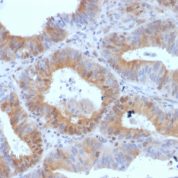 Formalin-fixed, paraffin-embedded Human Ovarian Carcinoma stained with LHCGR Monoclonal Antibody (LHCGR/1417).