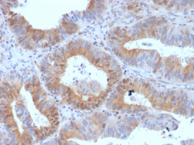 Formalin-fixed, paraffin-embedded Human Ovarian Carcinoma stained with LHCGR Monoclonal Antibody (LHCGR/1417).