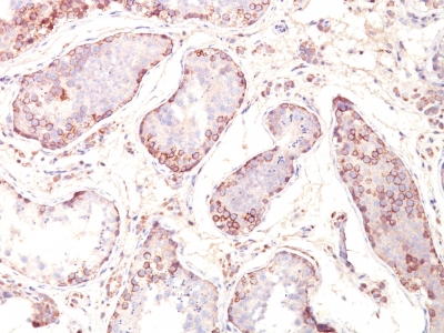 Formalin-fixed, paraffin-embedded human Testicular Carcinoma stained with MAGE-1 Monoclonal Antibody (MZ2E/838).