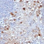 Formalin-fixed, paraffin-embedded human Melanoma stained with MCAM Monoclonal Antibody (MCAM/111)