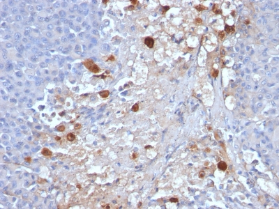Formalin-fixed, paraffin-embedded human Melanoma stained with MCAM Monoclonal Antibody (MCAM/111)