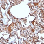Formalin-fixed, paraffin-embedded human Melanoma stained with MCAM Monoclonal Antibody (SPM62)