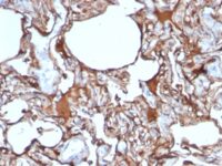 Formalin-fixed, paraffin-embedded human Melanoma stained with MCAM Monoclonal Antibody (SPM62)