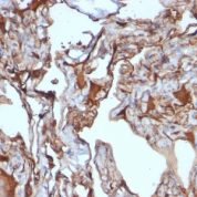 Formalin-fixed, paraffin-embedded human Melanoma stained with MUC18 Monoclonal Antibody (MUC18/113)