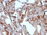 Formalin-fixed, paraffin-embedded human Melanoma stained with MUC18 Monoclonal Antibody (MUC18/113)