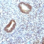 Formalin-fixed, paraffin-embedded human Thyroid Carcinoma stained with MAP3K1 Monoclonal Antibody (2F6).