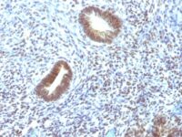 Formalin-fixed, paraffin-embedded human Thyroid Carcinoma stained with MAP3K1 Monoclonal Antibody (2F6).