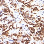 Formalin-fixed, paraffin-embedded human Breast Carcinoma stained with Milk Fat Globule Monoclonal Antibody (MFG-6)