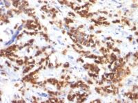 Formalin-fixed, paraffin-embedded human Breast Carcinoma stained with Milk Fat Globule Monoclonal Antibody (MFG-6)