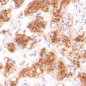 Formalin-fixed, paraffin-embedded human Breast Carcinoma stained with Milk Fat Globule Monoclonal Antibody (SPM291)
