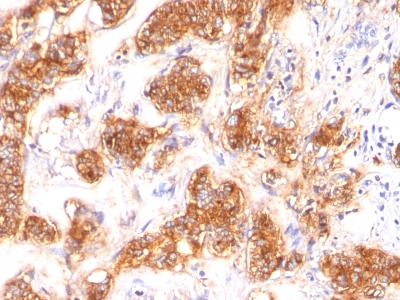 Formalin-fixed, paraffin-embedded human Breast Carcinoma stained with Milk Fat Globule Monoclonal Antibody (SPM291)