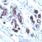 Formalin-fixed, paraffin-embedded human Breast Carcinoma stained with Milk Fat Globule Monoclonal Antibody (EDM45)