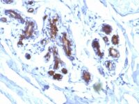 Formalin-fixed, paraffin-embedded human Breast Carcinoma stained with Milk Fat Globule Monoclonal Antibody (EDM45)