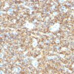 Formalin-fixed, paraffin-embedded human Testicular Carcinoma stained with CD99 Monoclonal Antibody (HO36-1.1).