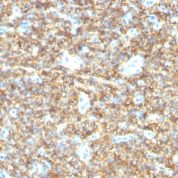 Formalin-fixed, paraffin-embedded human Testicular Carcinoma stained with CD99 Monoclonal Antibody (HO36-1.1).