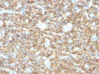 Formalin-fixed, paraffin-embedded human Testicular Carcinoma stained with CD99 Monoclonal Antibody (HO36-1.1).