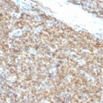 Formalin-fixed, paraffin-embedded human Ewing's Sarcoma stained with CD99 Monoclonal Antibody (12E7).