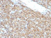 Formalin-fixed, paraffin-embedded human Ewing's Sarcoma stained with CD99 Monoclonal Antibody (12E7).