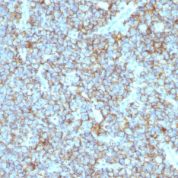 Formalin-fixed, paraffin-embedded human Ovarian Carcinoma & stained with CD99 Monoclonal Antibody (MIC2/877).