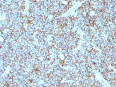 Formalin-fixed, paraffin-embedded human Ovarian Carcinoma & stained with CD99 Monoclonal Antibody (MIC2/877).